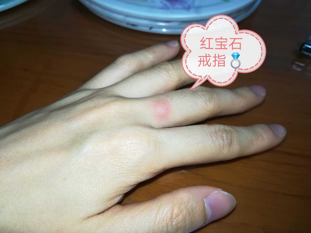 粗心大意手指碰了块淤青